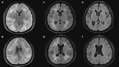 A Case Report of Central Nervous System Graft-Versus-Host Disease and Literature Review